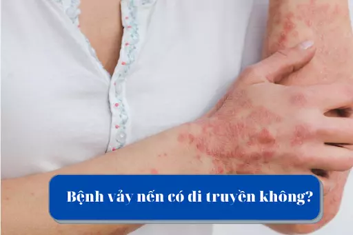 Bệnh vảy nến có di truyền không? Tìm hiểu ngay!